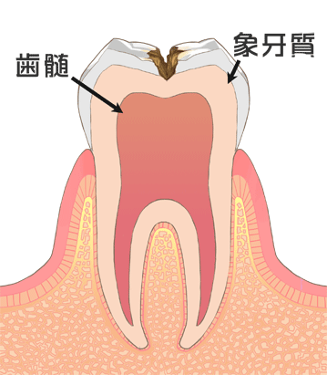 C2:象牙質まで進んだむし歯