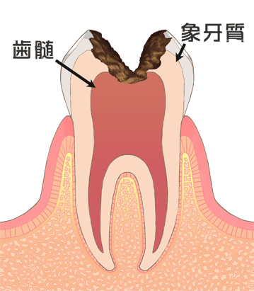C3:神経にまで進んだむし歯