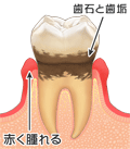 C2:象牙質まで進んだむし歯